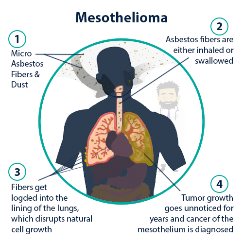 Malignant Mesothelioma | Diagnosis, Treatment and Support